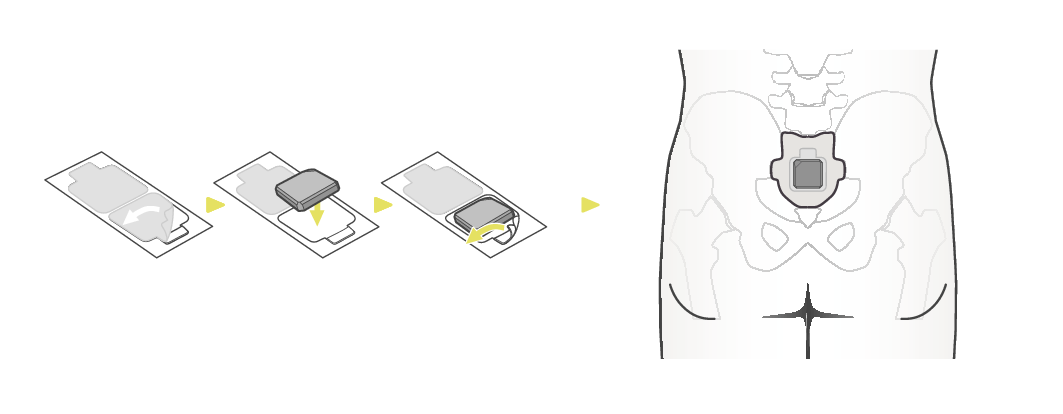 LEOMO_Motion_Sensors_Sacrum_S + LEOMO_Motion_Sensors_Sacrum_S
